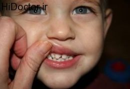 شکستگی در ناحیه دندانی در اطفال