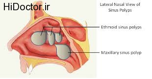 پلیپ در بینی و راههای پیشگیری از بروز آن