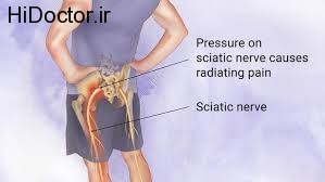 ابتلا به عارضه سیاتیک با مصرف این ماده