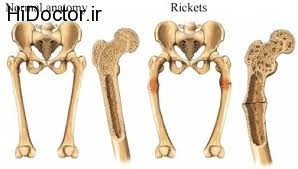 اطفال و اختلال نرمی در استخوان ها