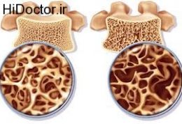 سیگارکشیدن و پوکی استخوان