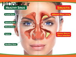 جراحی با وجود مشکل سینوس ها