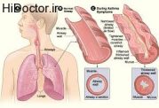 عوامل مهم در پیدایش حملات آسم