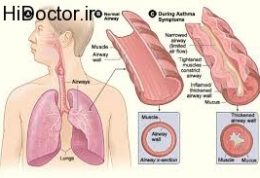 عوامل مهم در پیدایش حملات آسم