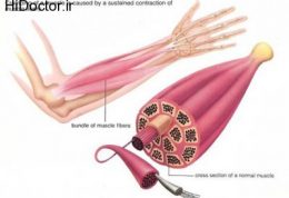اطلاعاتی مناسب راجع به گرفتگی در عضلات