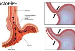 ریفلاکس و متد جدید درمانی برای آن