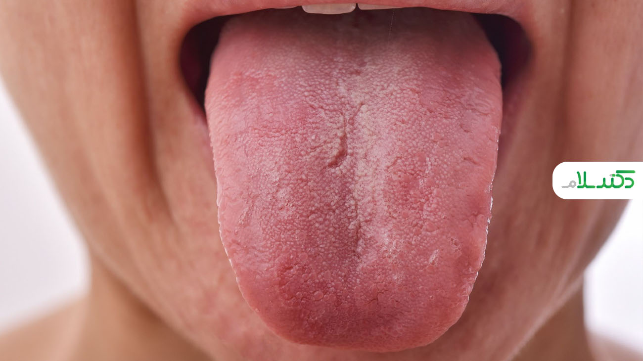 عوارض ترک خوردن زبان