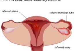بیماری التهابات رحمی