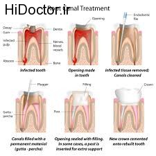 همه مراحل ترمیم و رفع مشکلات ریشه دندان