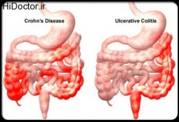 با بیماری کرون بیشتر آشنا شوید