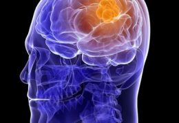 استفاده زیاد از موبایل و ابتلا به تومور مغزی