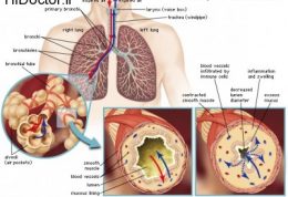 با این علائم شما مبتلا به آسم هستید