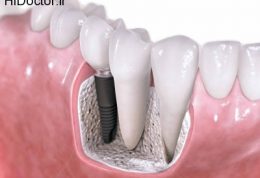 توصیه های مهم دندانپزشکان راجع به ایمپلنت