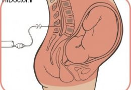 زایمان کردن با کمک روش اپیدورال