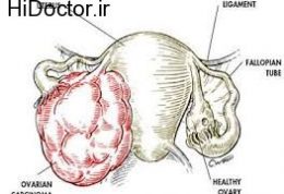 علائم و نشانه های سرطان در تخمدان