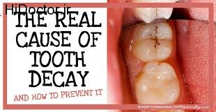 تاثیرگذارترین عوامل در پوسیدگی دندان