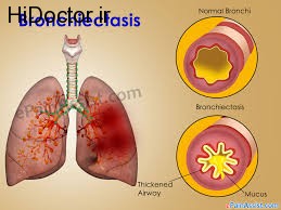 درباره برونشکتازی بیشتر بدانیم