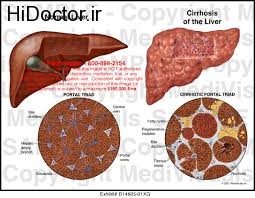 بیماری خطرناک و پرهزینه کبدی