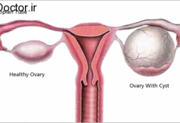 نازا شدن به خاطر کیست تخمدان