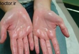 توصیه های پزشکان در رابطه با عرق کف دست
