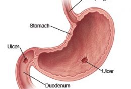 زخم معده و دانستنی های مهم در مورد آن