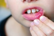 روش های خانگی برای درمان زخم های دهانی