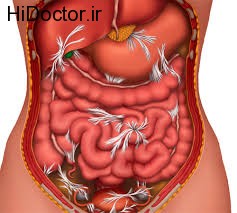 با مشکل چسبندگی روده چگونه کنار بیاییم