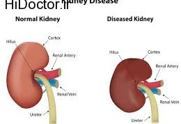 تهدید مشکلات کلیوی برای این افراد