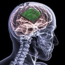 بازیابی حافظه آسیب دیده با کاشت این وسیله در مغز