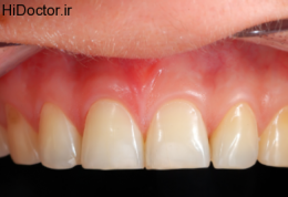 التهاب لثه را با بیماری لثه اشتباه نگیرید!
