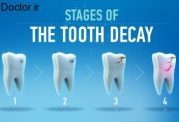 رعایت نکات مهم درباره پوسیدگی دندان