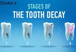 رعایت نکات مهم درباره پوسیدگی دندان