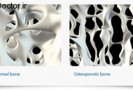 یکی از علل های مهم پوکی استخوان