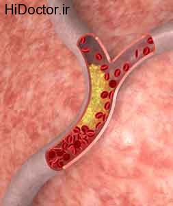 بهترین و سریعترین راههای پایین آوردن کلسترول