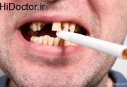 از دست دادن دندان با استعمال دخانیات