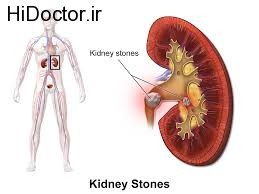 بروز سنگ در سیستم ادراری با این موارد