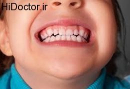 مراقبت از دندان های کودک با این شرایط