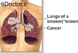 تهدید این سرطان برای سیگاری ها