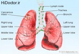 تهدید سرطان ریه با زندگی در این موقعیت ها