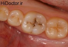 اهمیت رسیدگی به پوسیدگی دندان