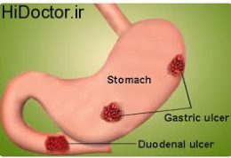 مطالبی در زمینه زخم های گوارشی