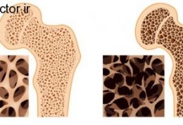 از پوک شدن استخوان بیشتر بدانید