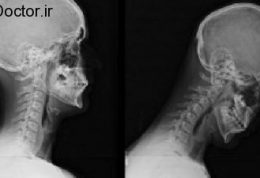 گردن پیامکی و این روش های مقابله