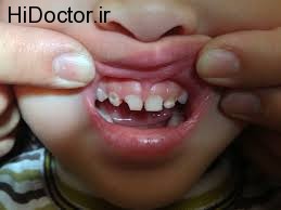 جالب ترین موارد تخریب کننده دندان