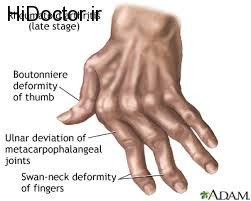 تهدید بیماری آرتریت روماتوئید برای این افراد