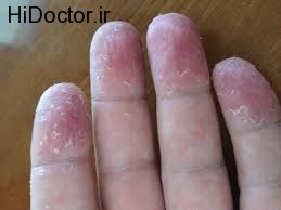 درمان های طبیعی برای پوسته شدن نوک انگشتان