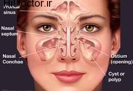 پیشنهاد درمانی برای درد سینوزیت