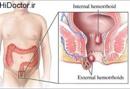 سنین بالا و عارضه هموروئید