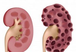 اطلاعات جامع در مورد کیست کلیه