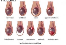 مشکل رایج در بیضه